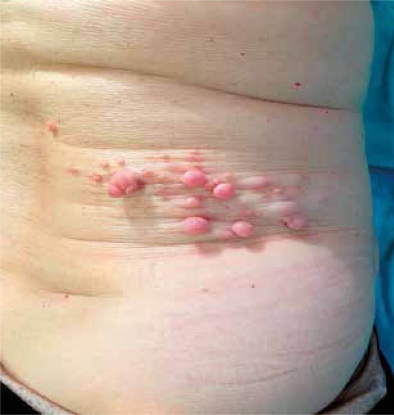 Segmental neurofibromatosis