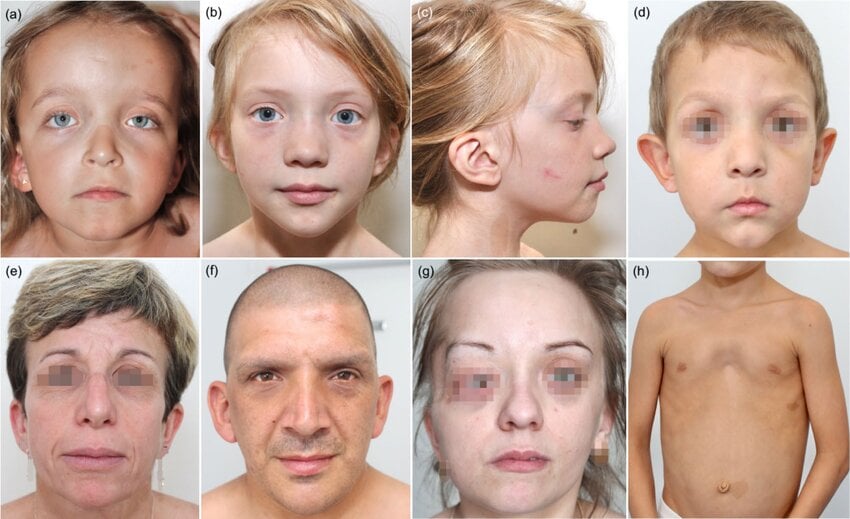 Forrás: Didier Bessis és mtsai. Neurofibromatosis-Noonan syndrome: a prospective monocentric study of 26 patients and literature review. Orphanet Journal of Rare Diseases, 2025. Licenc: CC BY 4.0 A kép módosítva